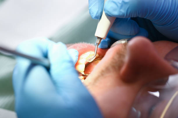 Best Knocked-Out Tooth (Avulsed Tooth) Treatment in Shady Cove, OR